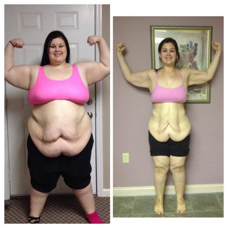 This Woman’s Supposed To Get A Stomach Reduction But What She Does